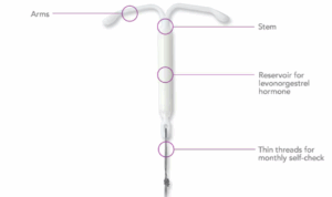Hormonal IUD – Long-Lasting & Effortlessly Effective