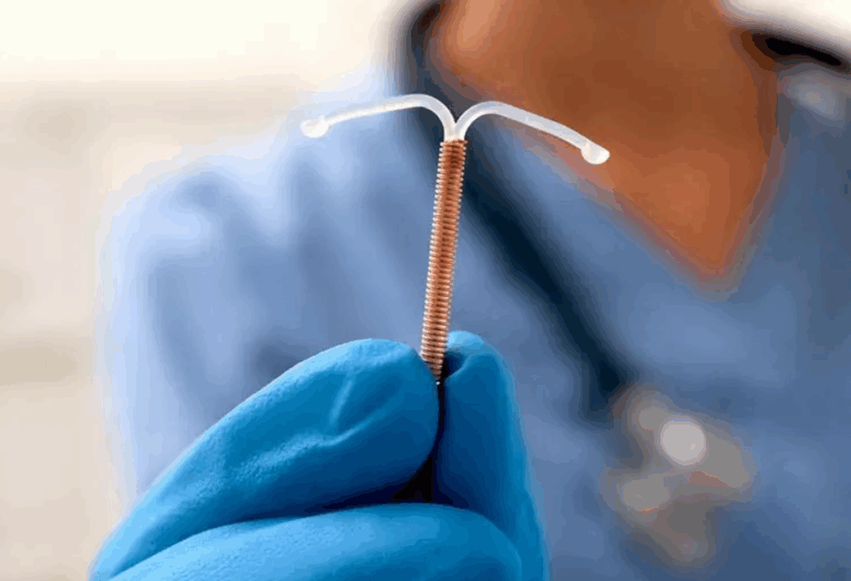 Copper IUD – Hormone-Free & Lasts Up to 10 Years